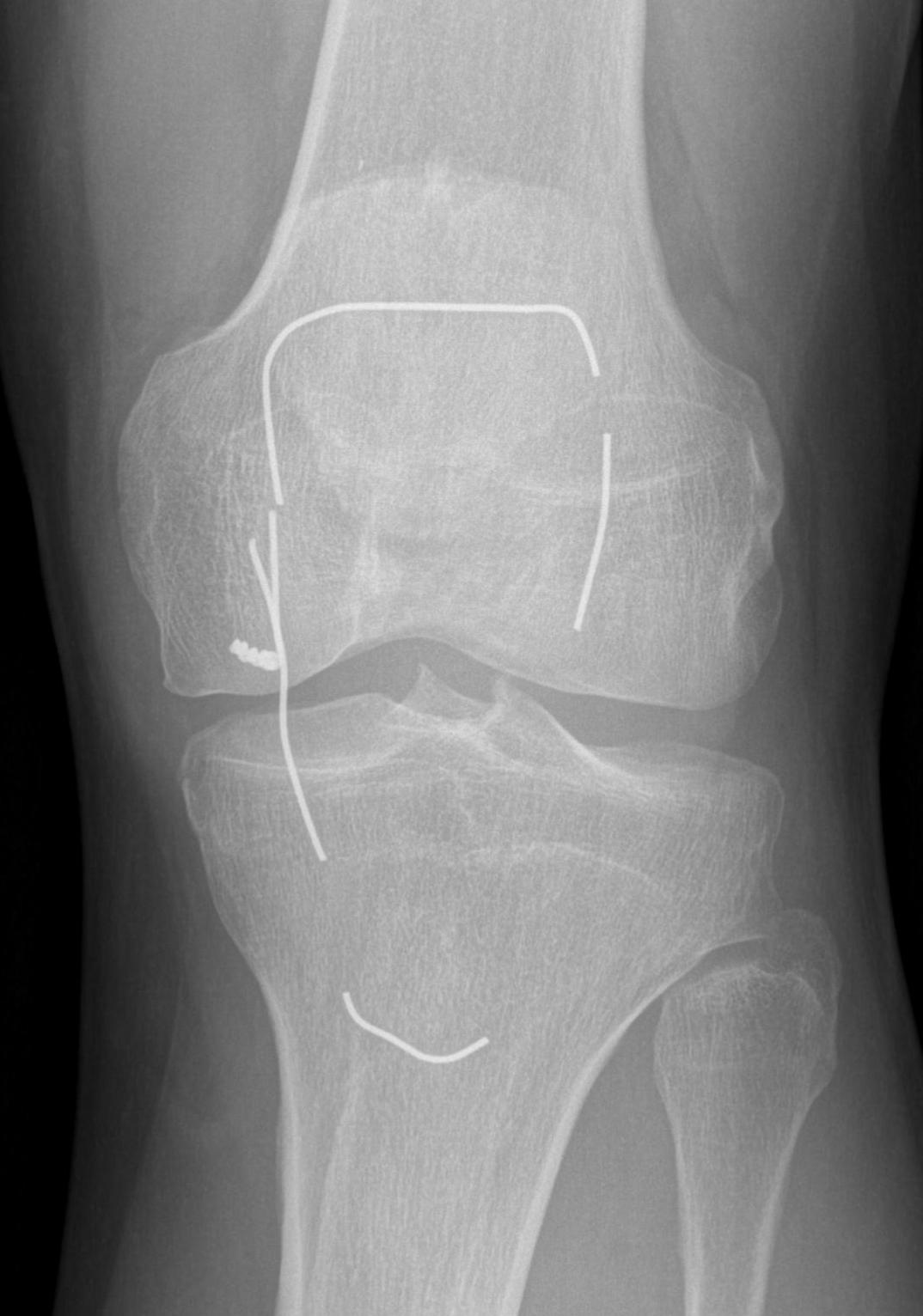 Patella Box Wire Broken AP